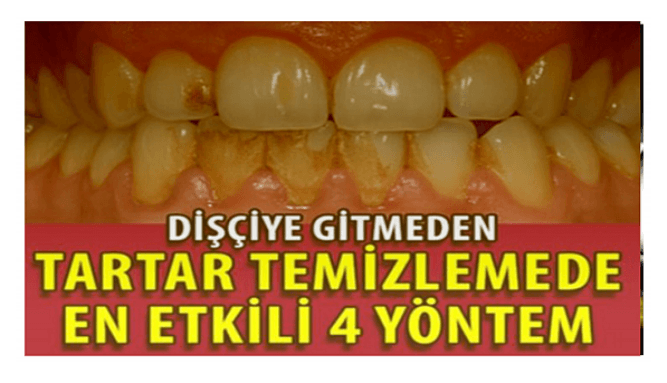 DİŞÇİYE GİTMEDEN TARTAR TEMİZLEMEK MÜMKÜN! EVDE TARTAR TEMİZLEME